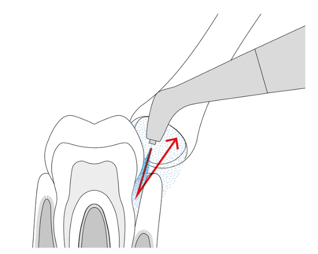 Oral Prophylaxis Cleaning